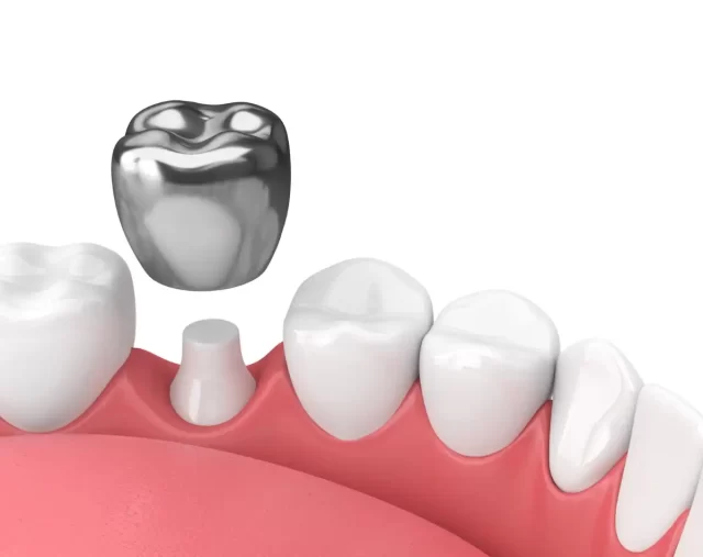 Homeodent Crown Teeth Borivali West for Adults and teens
