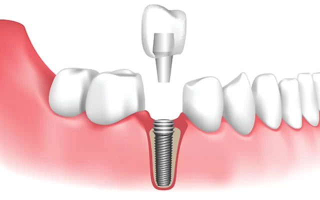 Homeodent Dental Implant Borivali West for Adults and teens 1