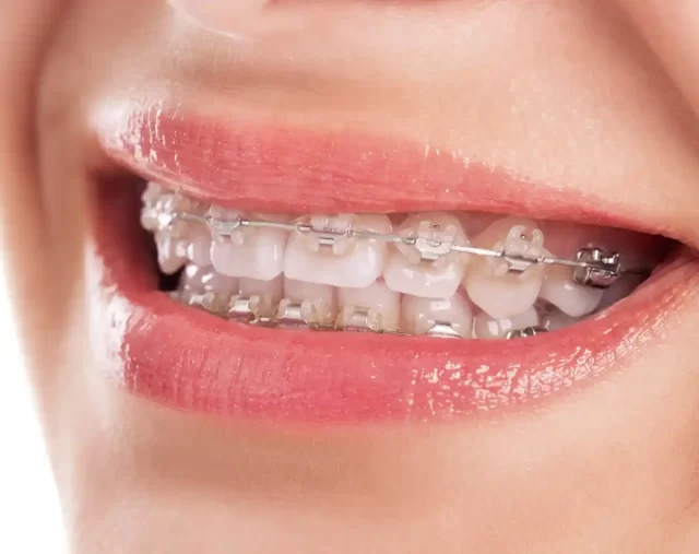 Homeodent Metal Braces Borivali West for Adults