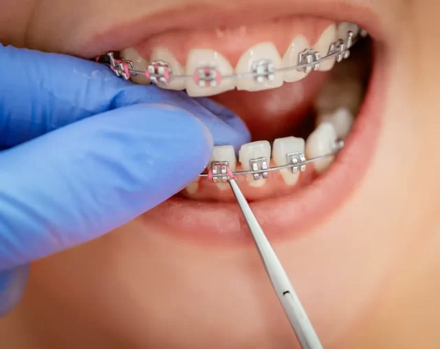 Homeodent Metal Braces Borivali West for Adults and teens 1