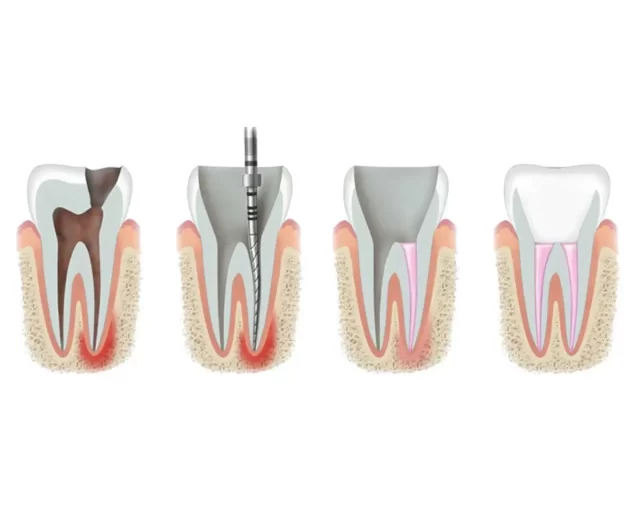 Homeodent Root Canal Borivali West for Adults and teens