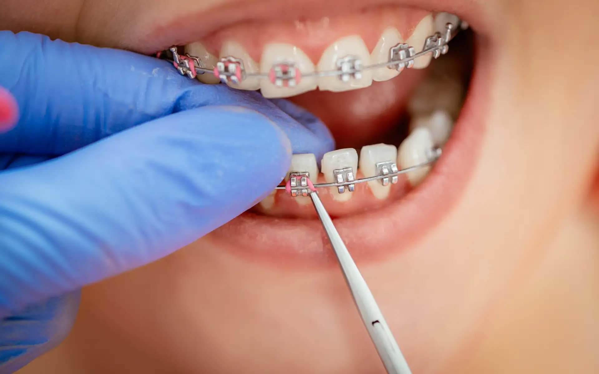 https://homeodent.co.in/wp-content/uploads/2022/10/Homeodent-Teeth-Braces-Borivali-West-for-Adults-and-teens.webp