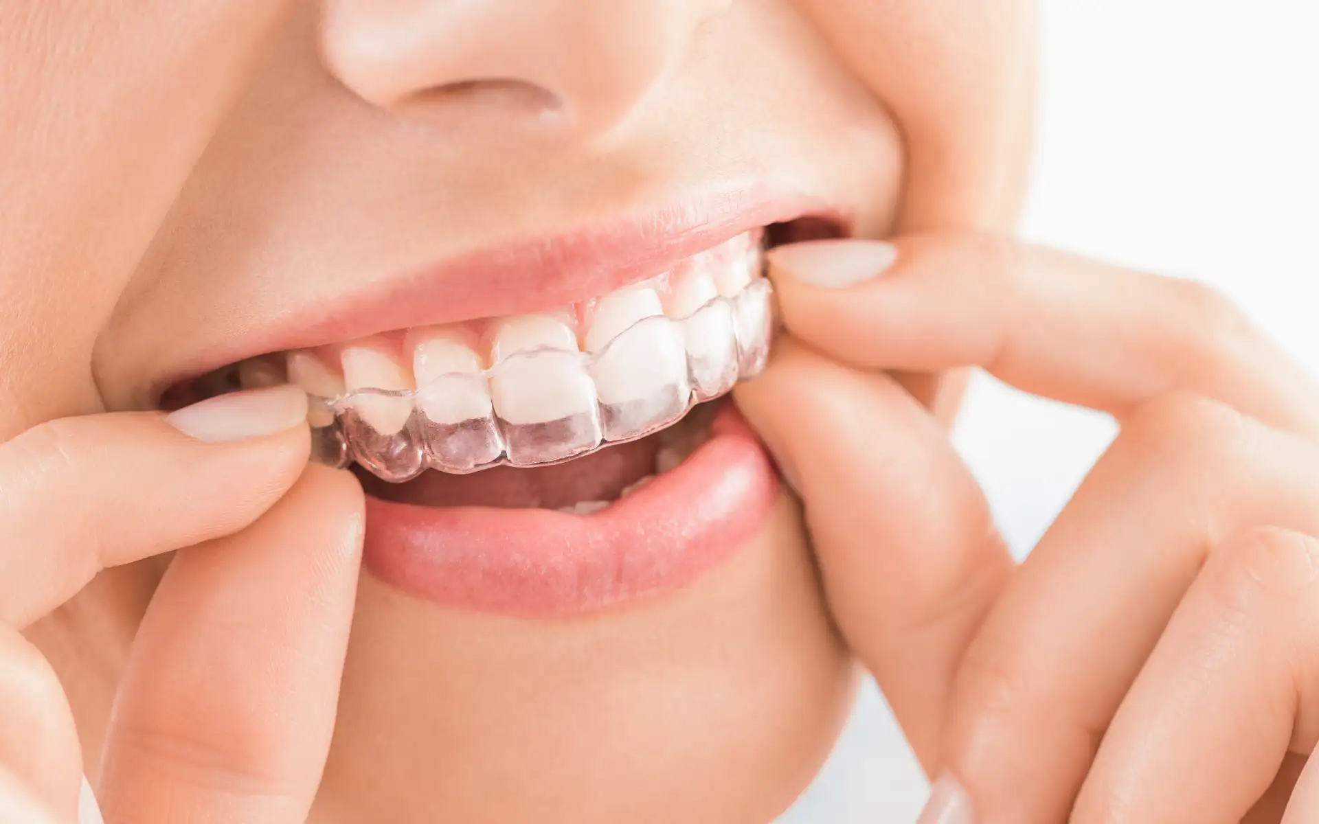 https://homeodent.co.in/wp-content/uploads/2022/10/Homeodent-invisalign-Borivali-West-for-Adults-and-teens.webp