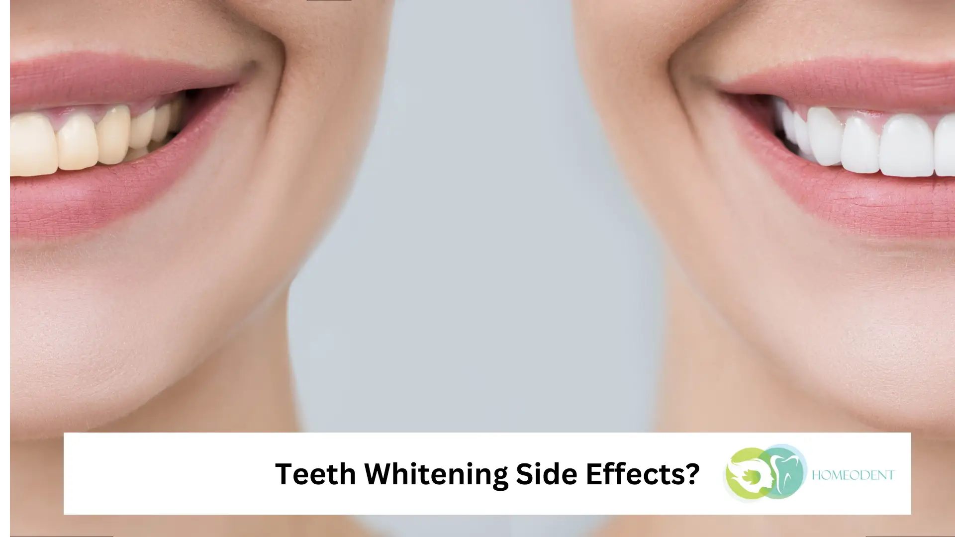 What Are the Most Common Teeth Whitening Side Effects 3