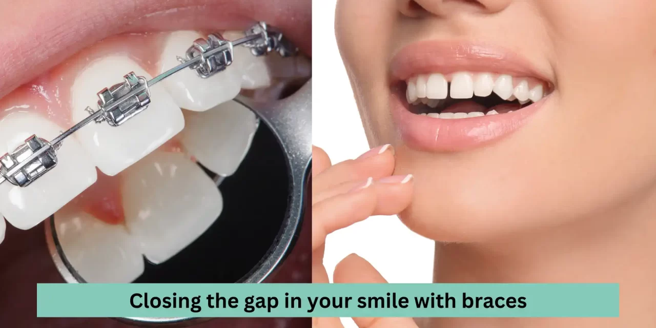 Closing The Gap in Your Smile with Braces: Your Fast-Track to a Gap-Free Smile in India!
