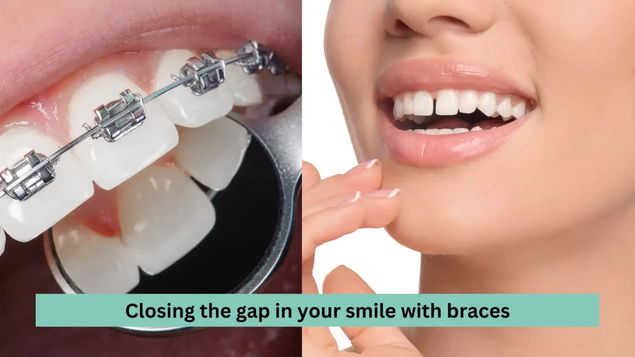 Closing the gap in your smile with braces Your fast track to a gap free smile in India Homeodent