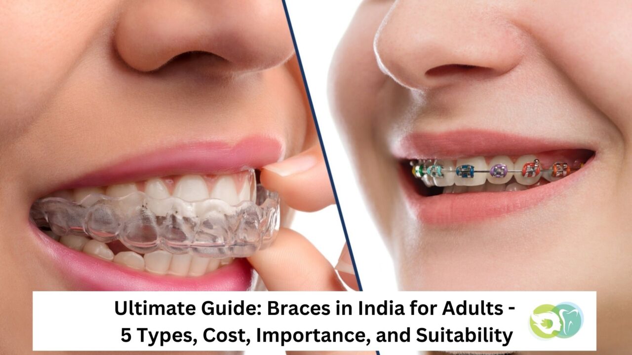 Braces in India for Adults