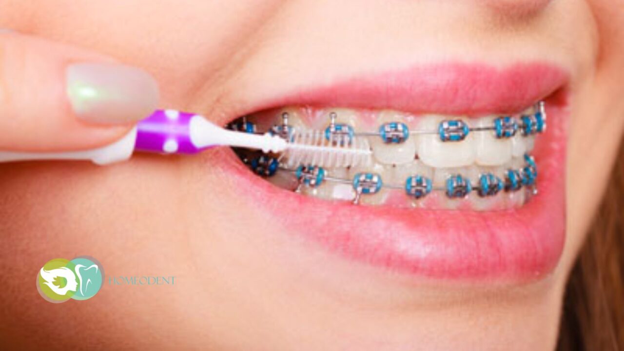 Teeth Straightening for Metal Braces