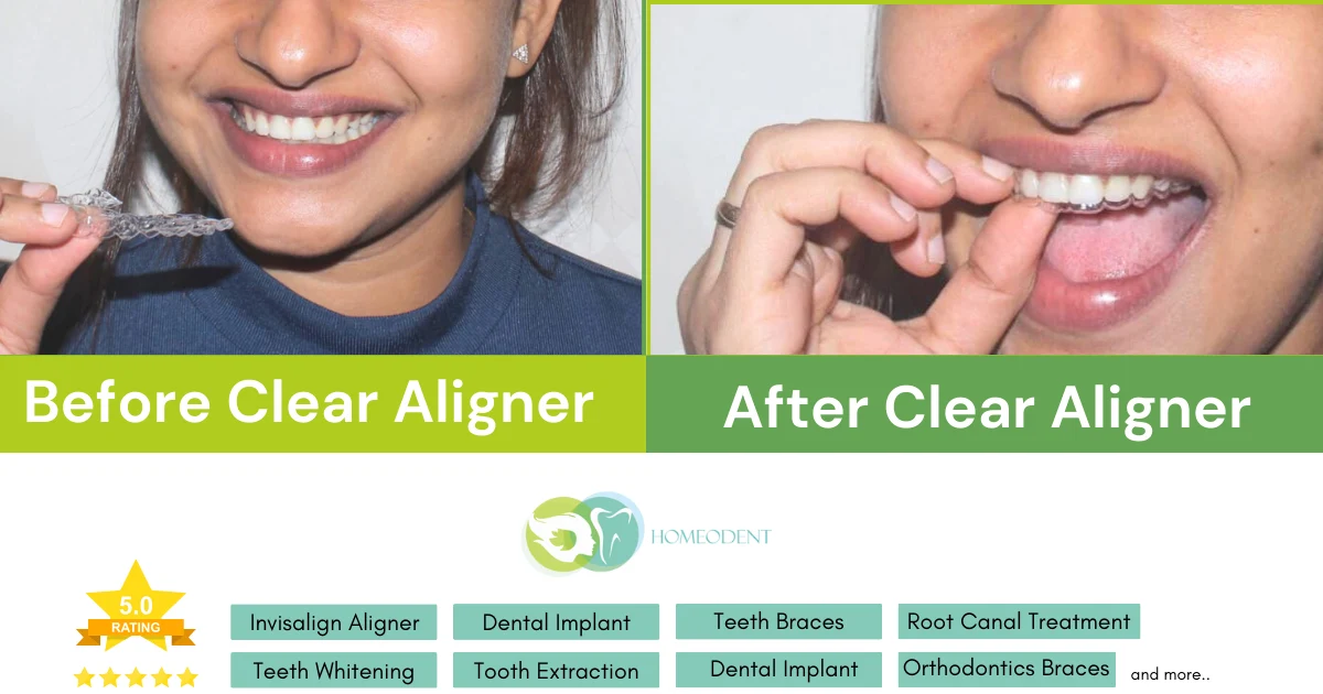 Clear aligners in borivali are made of a clear plastic material that is custom-made to fit your teeth - Orthodontist in Borivali Homeodent Multispeciality Orthodontic Clinic