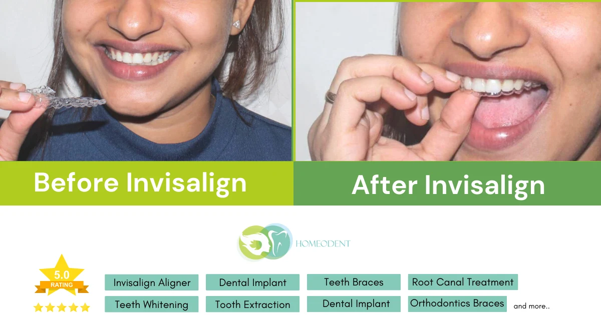 Invisalign aligners in borivali before and after wearing invisalign aligner - Orthodontist in Borivali Homeodent Multispeciality Orthodontic Clinic