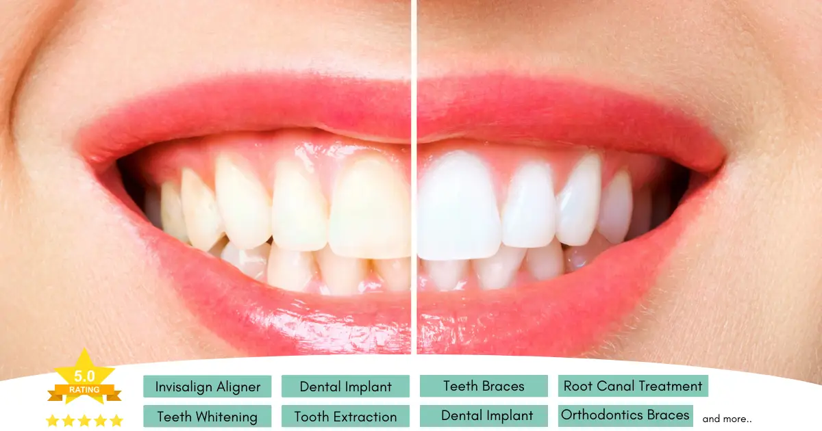 What Is Teeth Whitening by Dentist in Borivali Homeodent Multispeciality Orthodontic Dental Clinic 1