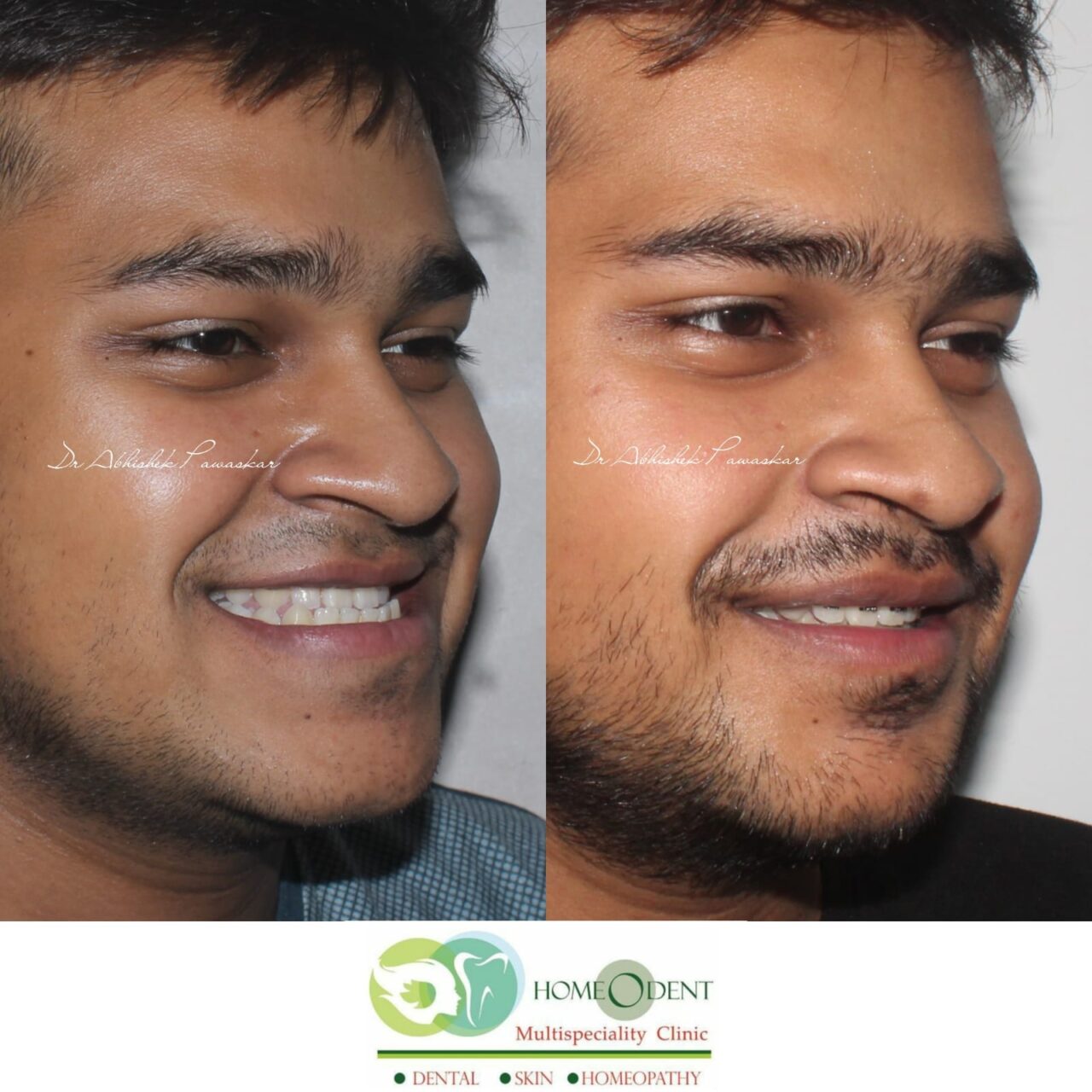 Orthognathic surgeries, also known as corrective jaw surgery, is a life-changing procedure that corrects a range of skeletal and dental irregularities