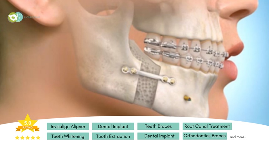 What are Orthognathic Surgeries, cost and its types?