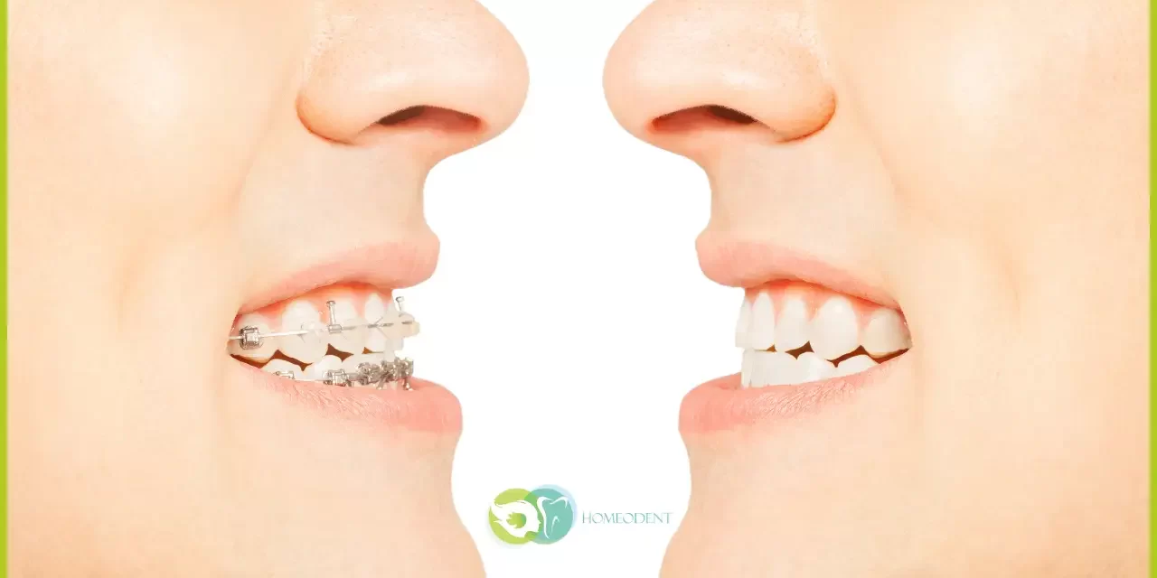 Metal Braces in Borivali | Benefits and Contact Dentist in Borivali