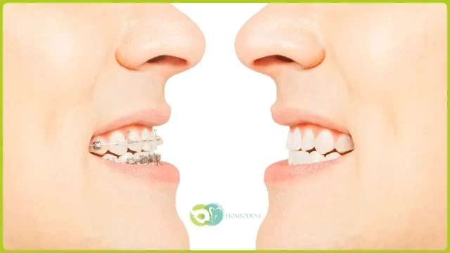 Metal Braces in Borivali