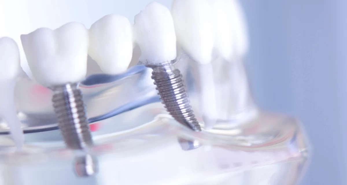 A Smile That Lasts: The Power of Dental Implants