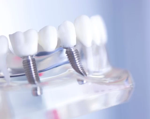 Dental Implants